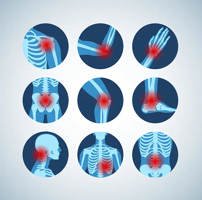 Arthritis joint pain syndrome