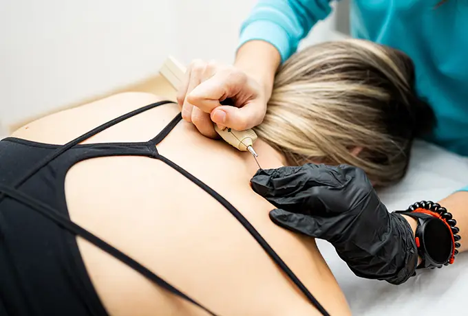 Neuromodulation Technique cottleville mo